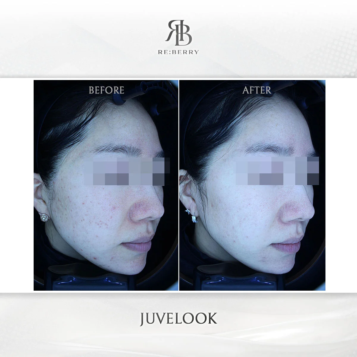 Same-day Juvelook treatment before and after result